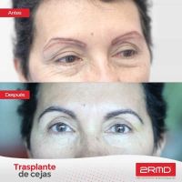Trasplante de cejas y pestañas: recomendaciones de 2RMD expertos en trasplante capilar
